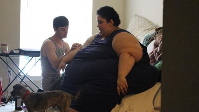 Obesitas parah (Img: Daily Mail)